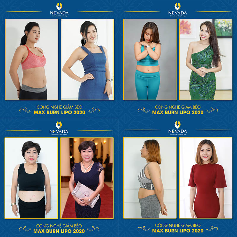Kết quả giảm béo của một số Sao Việt tại Thẩm mỹ viện Quốc tế Nevada