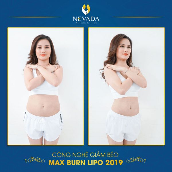 Quy trình giảm béo Max Burn Lipo